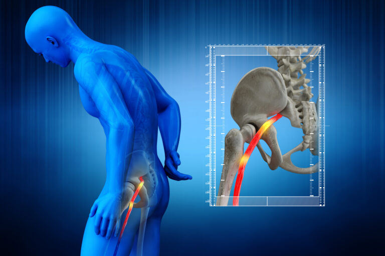 Pinched human sciatic nerve, anatomical vision. 3D Render